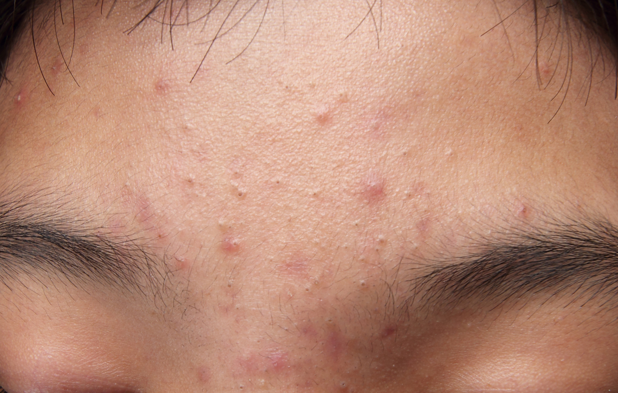 Benefits of Low Dose Accutane Therapy