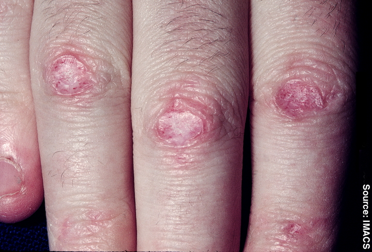 What is Dermatomyositis?