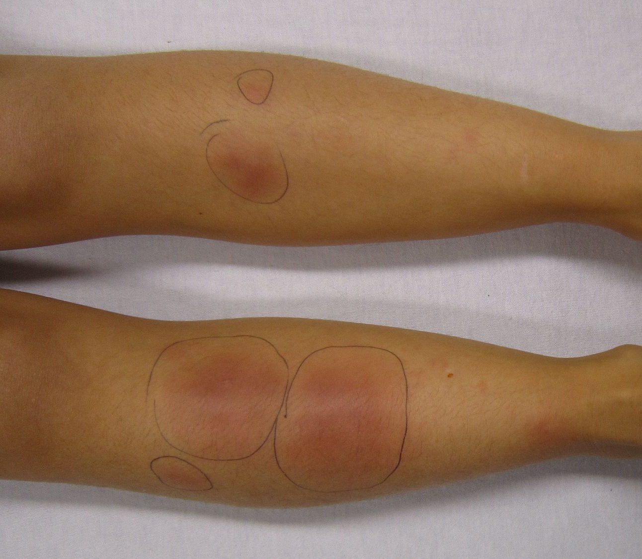 Erythema Nodosum Treatment in Austin, TX