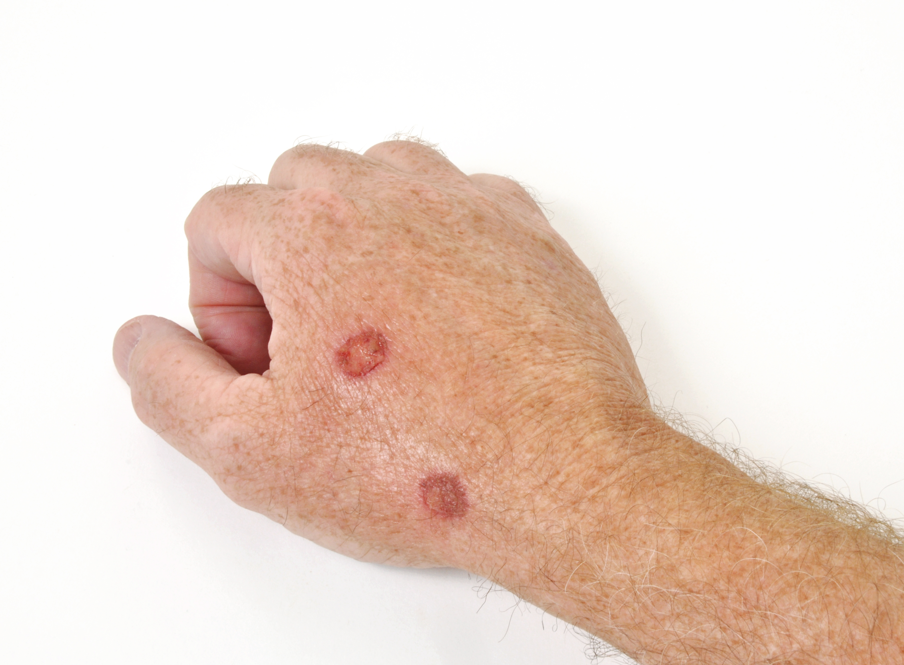 Squamous Cell Carcinoma Treatment in Austin, TX