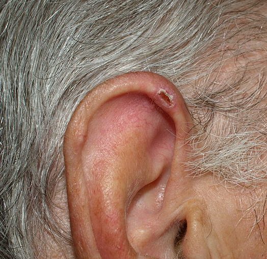 Chondrodermatitis Nodularis Helicis in Austin, TX