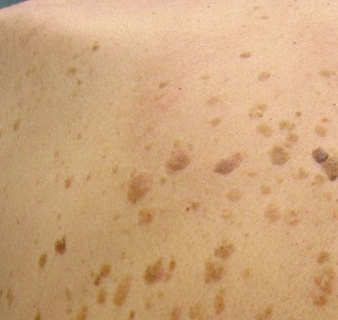 What Are The Best Treatments For Seborrheic Keratosis