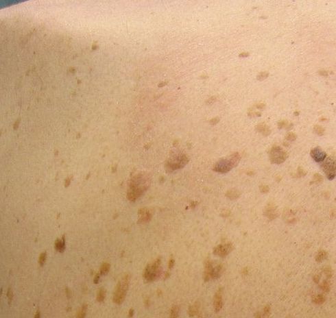 Seborrheic Keratosis Treatment in Austin, TX