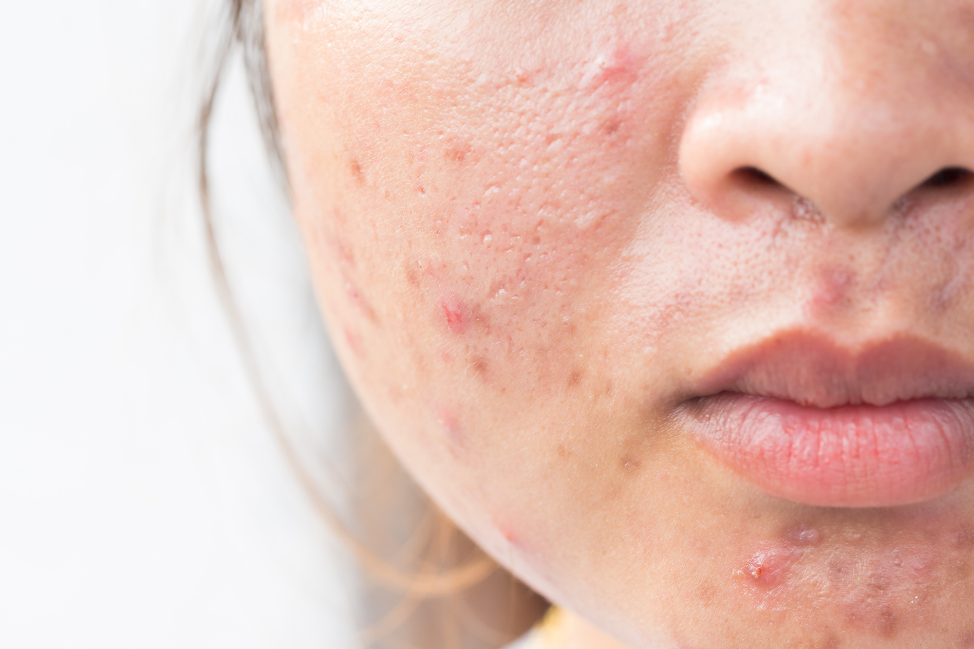 Chemical Peels for Acne in Austin, TX