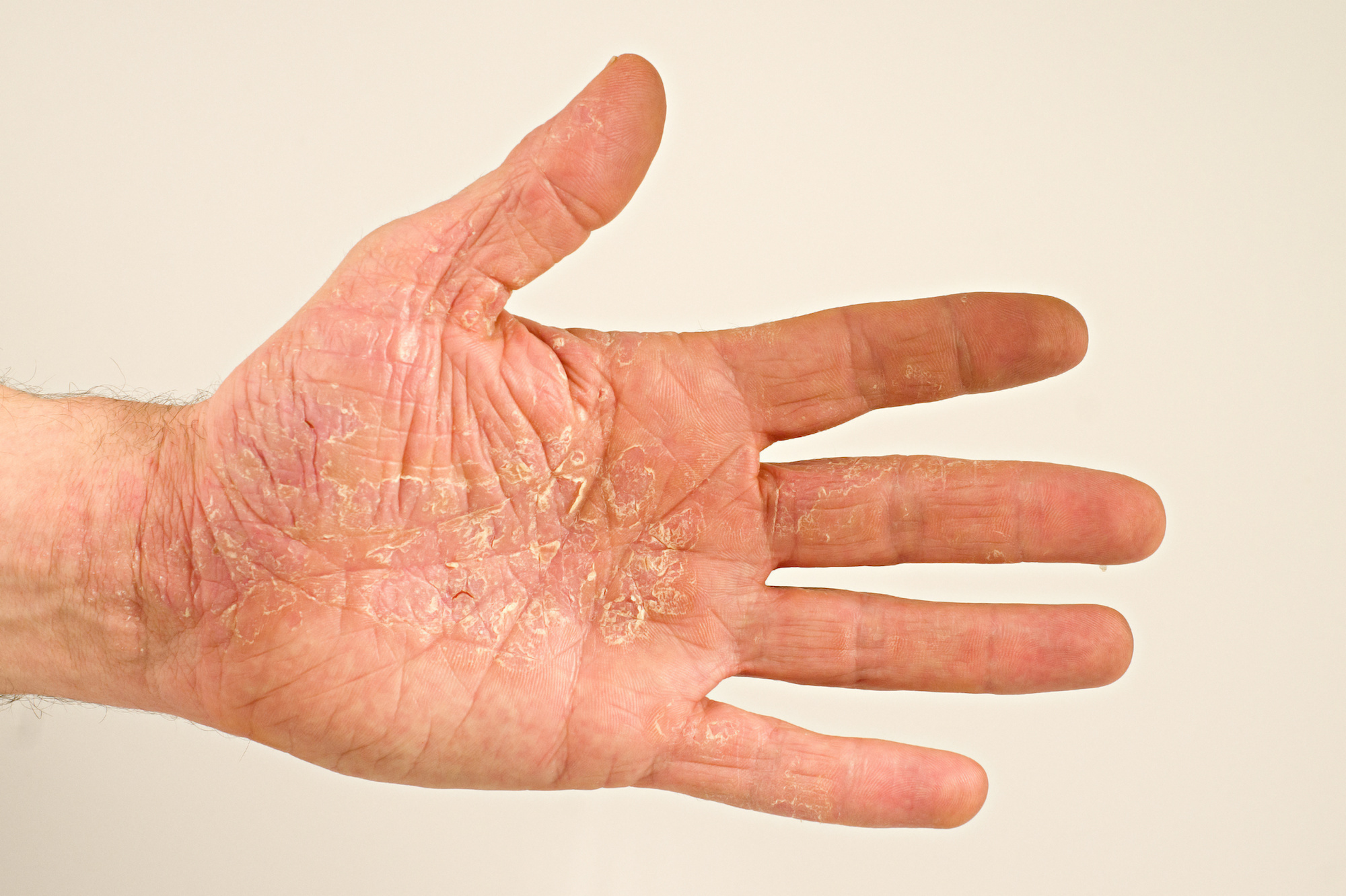 Tips to protect hands from washing dishes