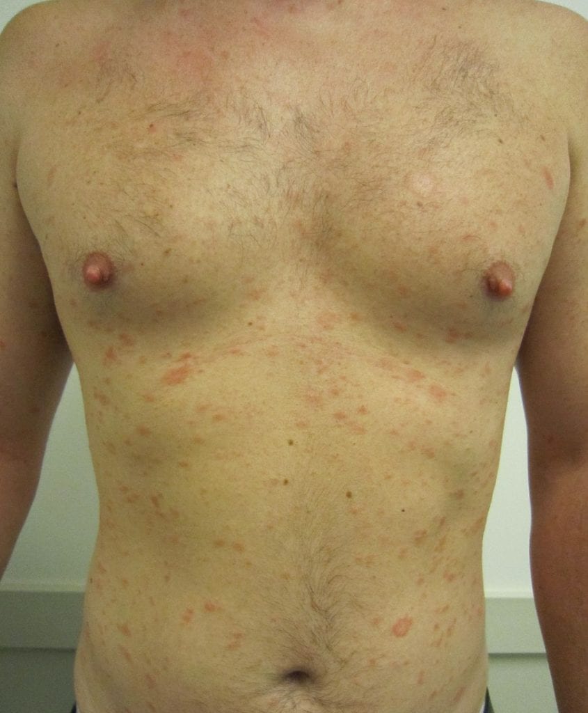 Understanding Pityriasis Rosea