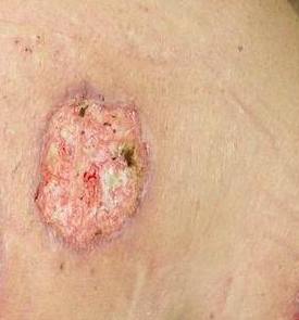 Pyoderma Gangrenosum in Austin, TX