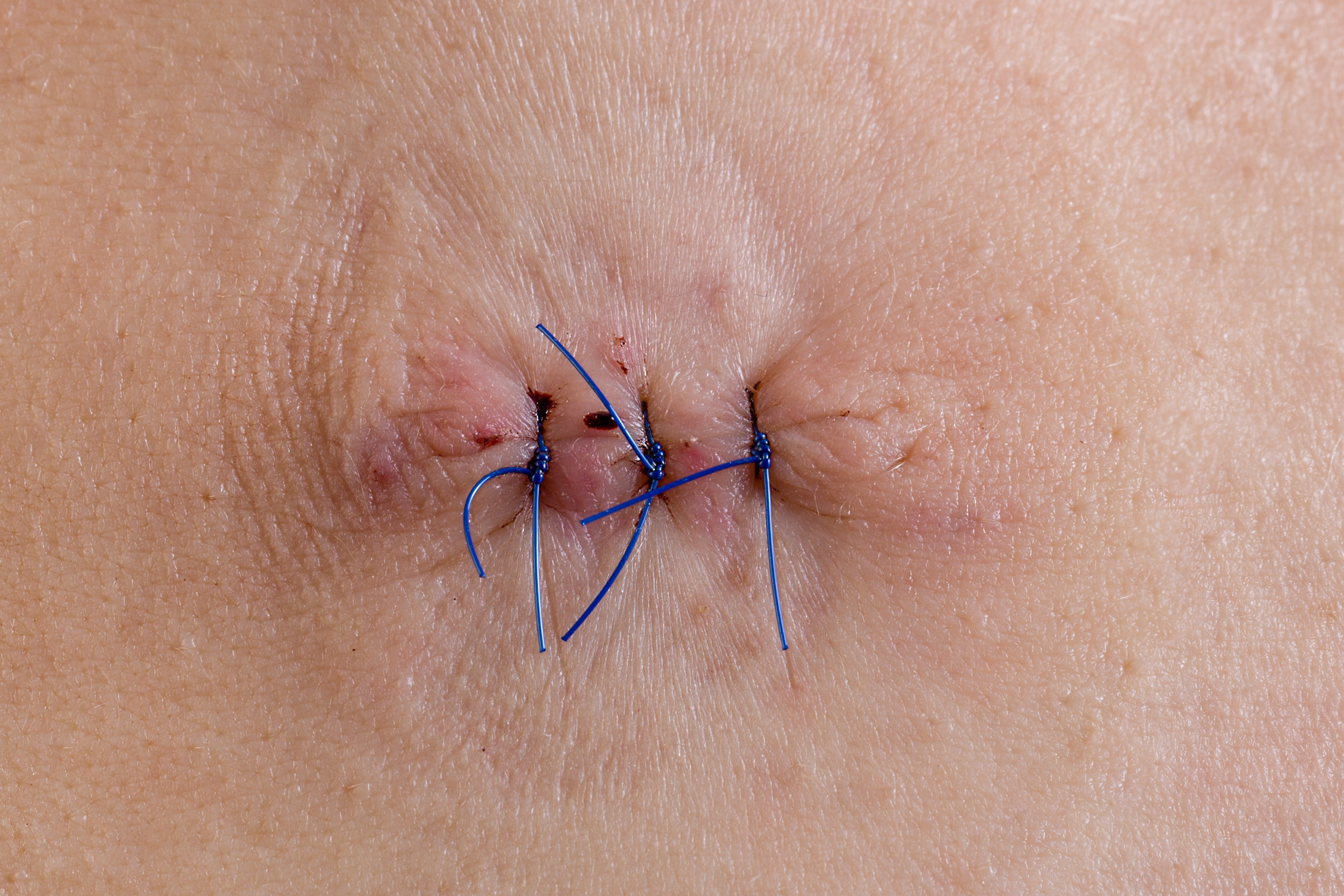 Suture Granuloma in Austin, TX