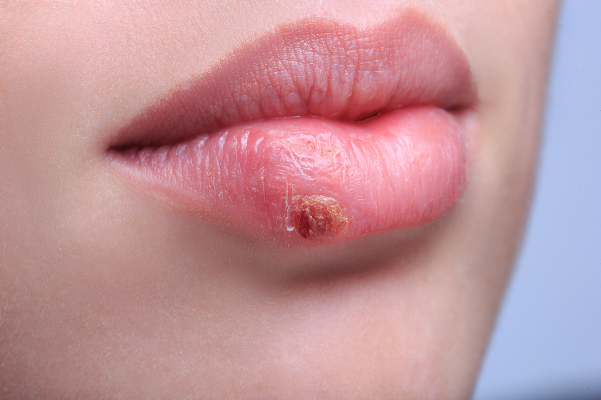 What is a cold sore?