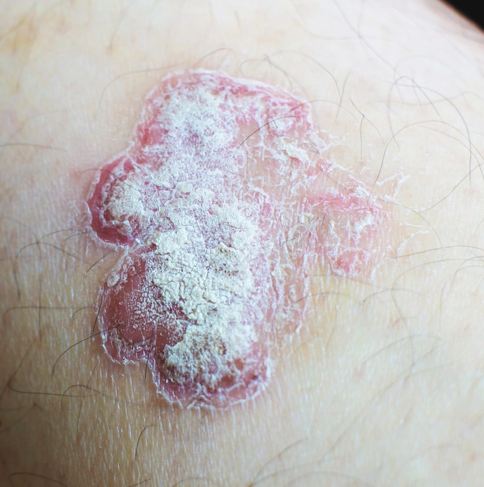 Psoriasis Treatment in Austin, TX