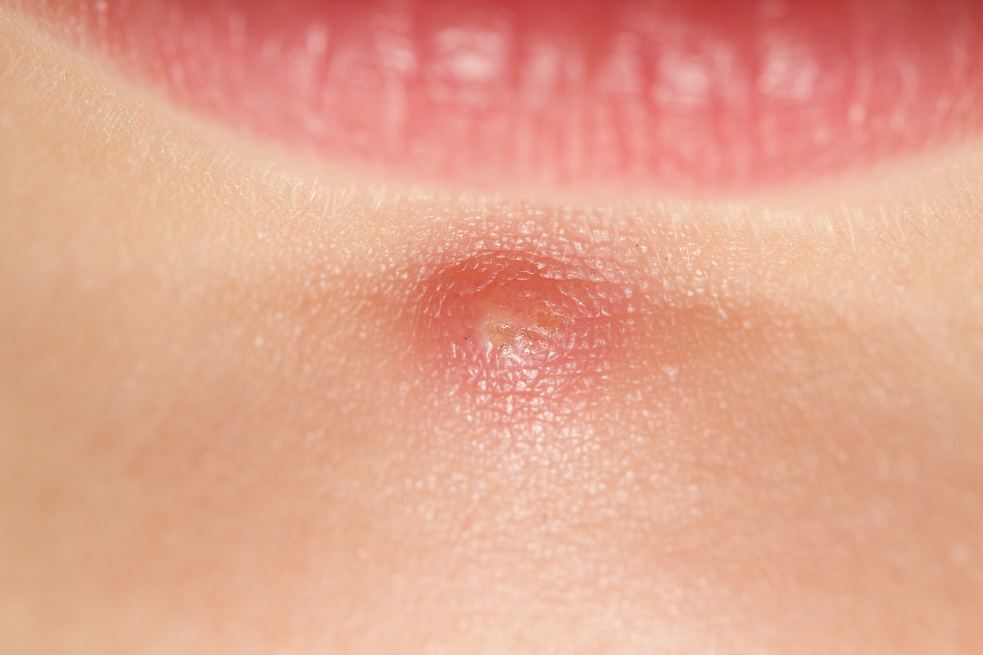 Acne Treatment in Austin, TX