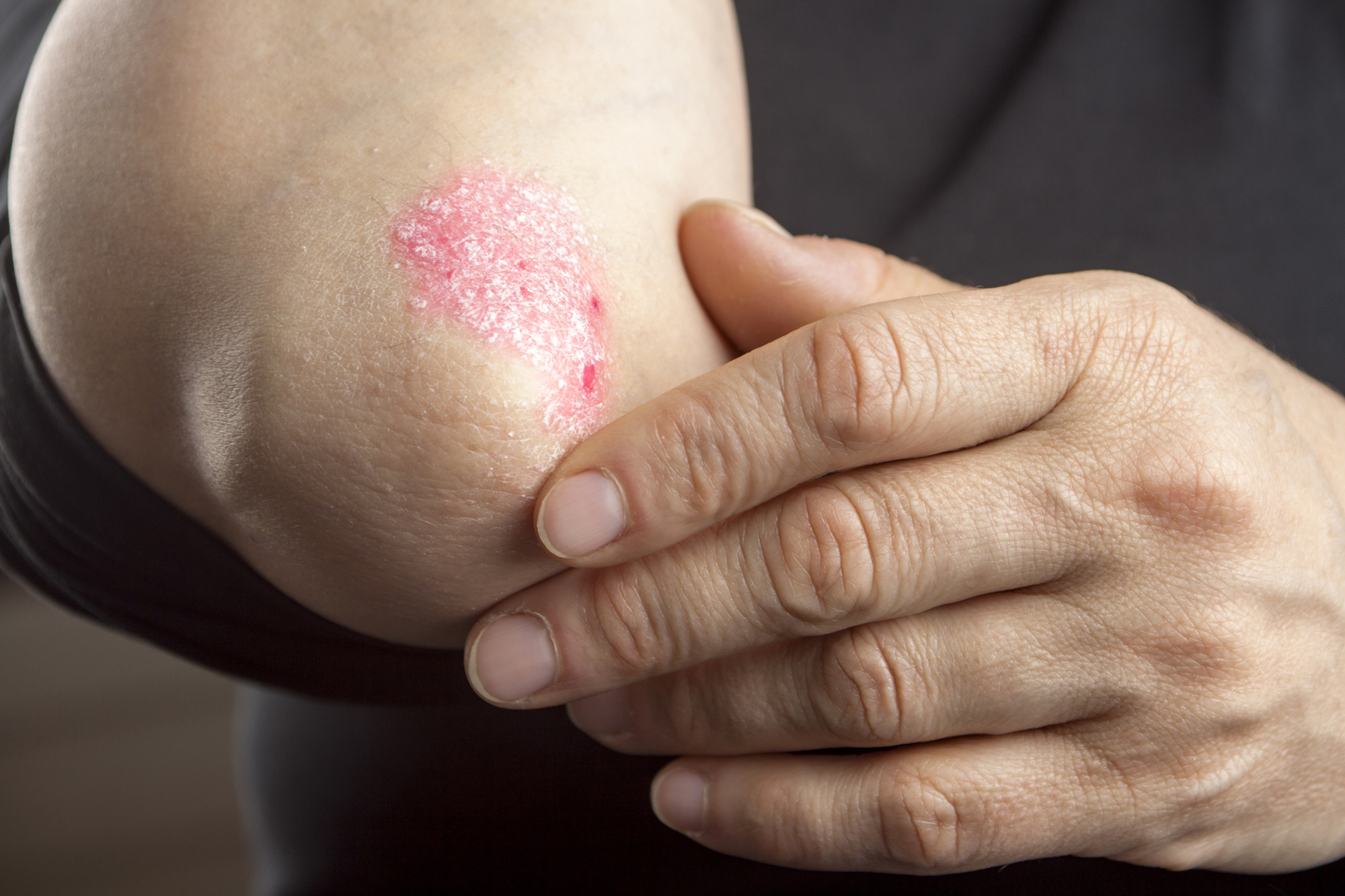 Eczema vs. Squamous Cell Carcinoma: How Can You Tell The Difference?