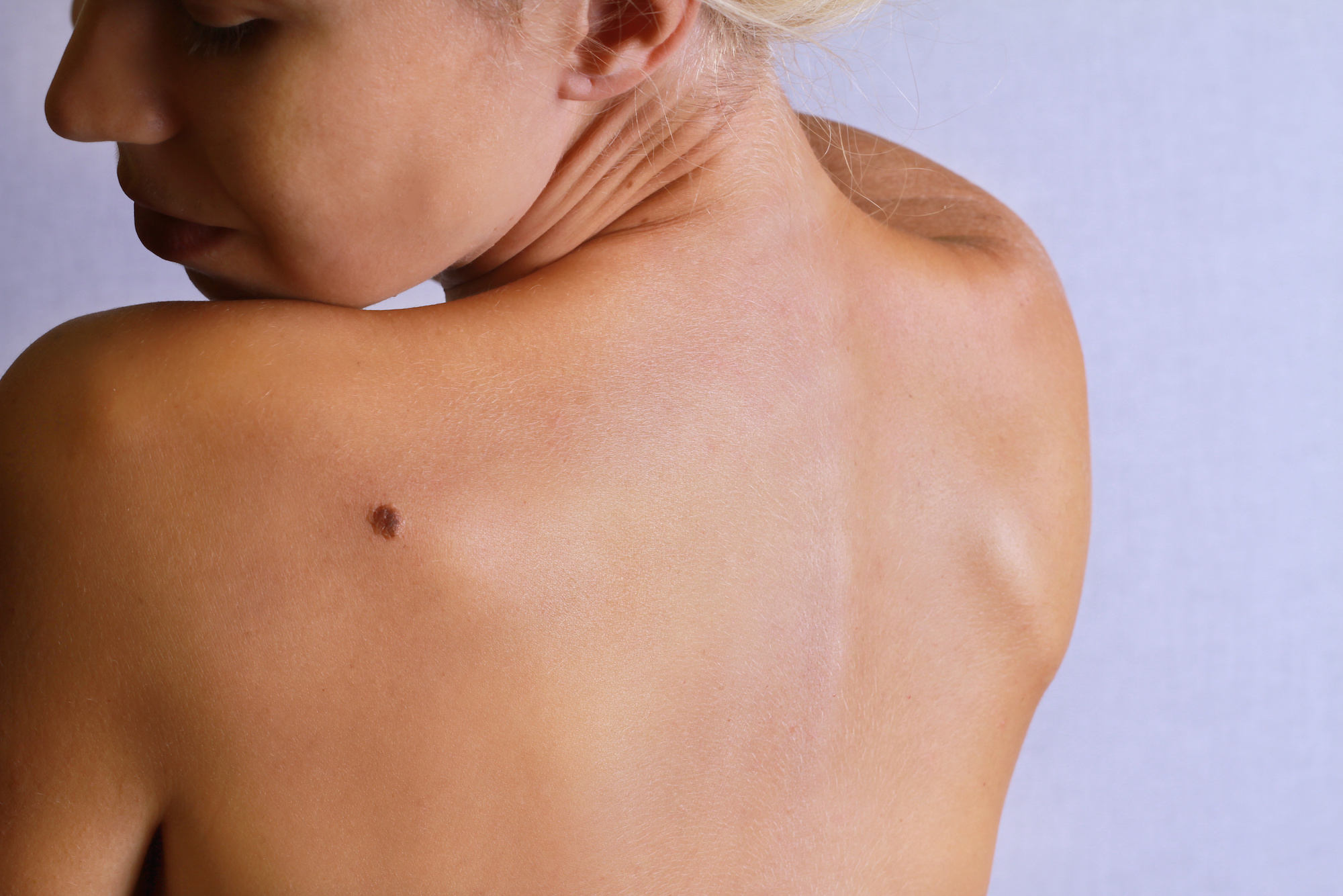 Birthmarks Removal in Austin, TX