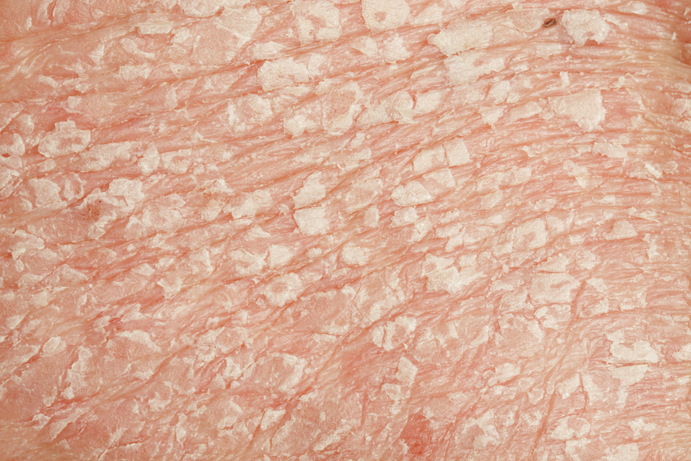 Psoriasis Treatment in Austin, TX