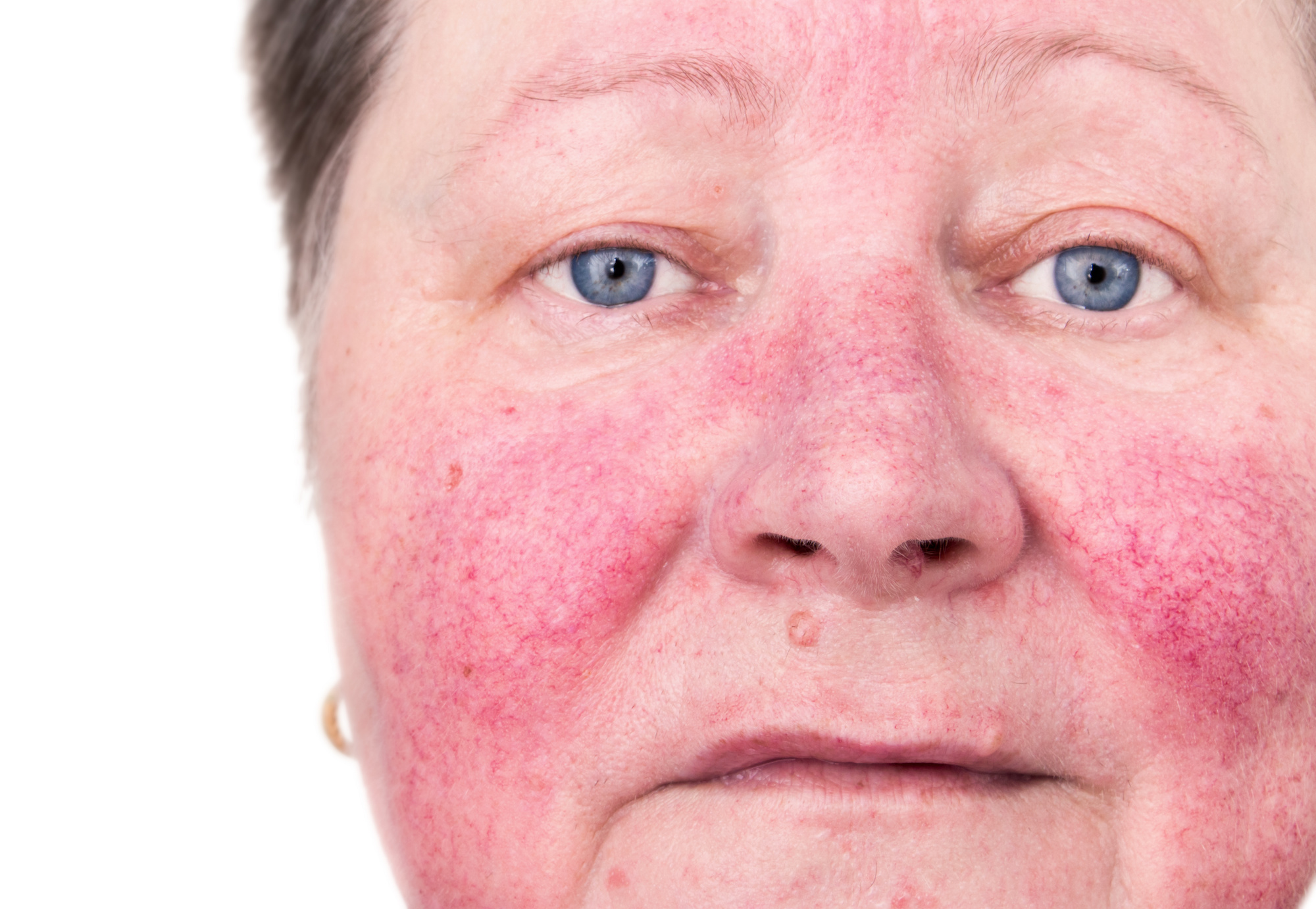 Azelaic Acid in Austin, TX