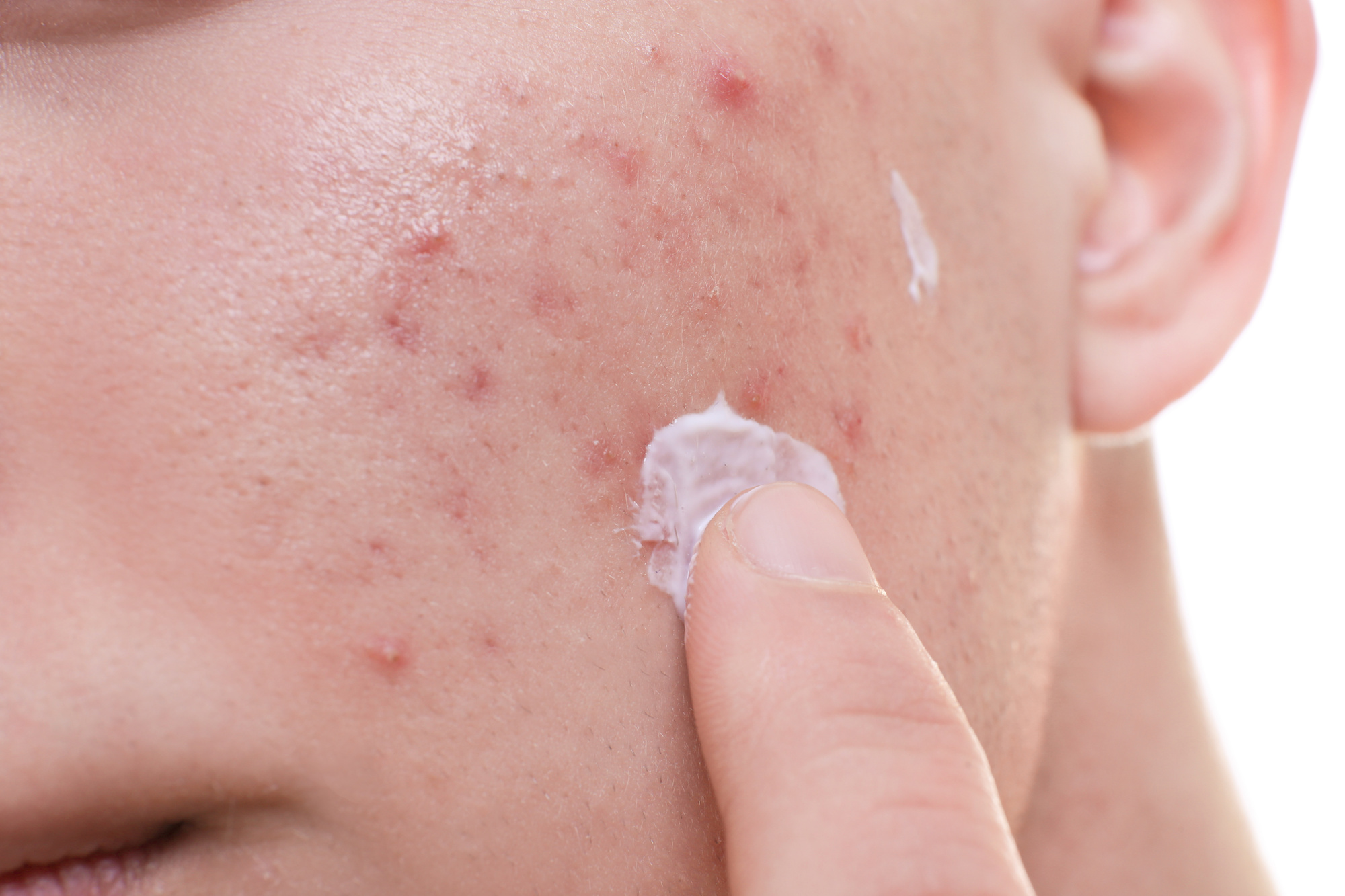 What You Need To Know Before Using Topical Antibiotics To Treat Your Acne