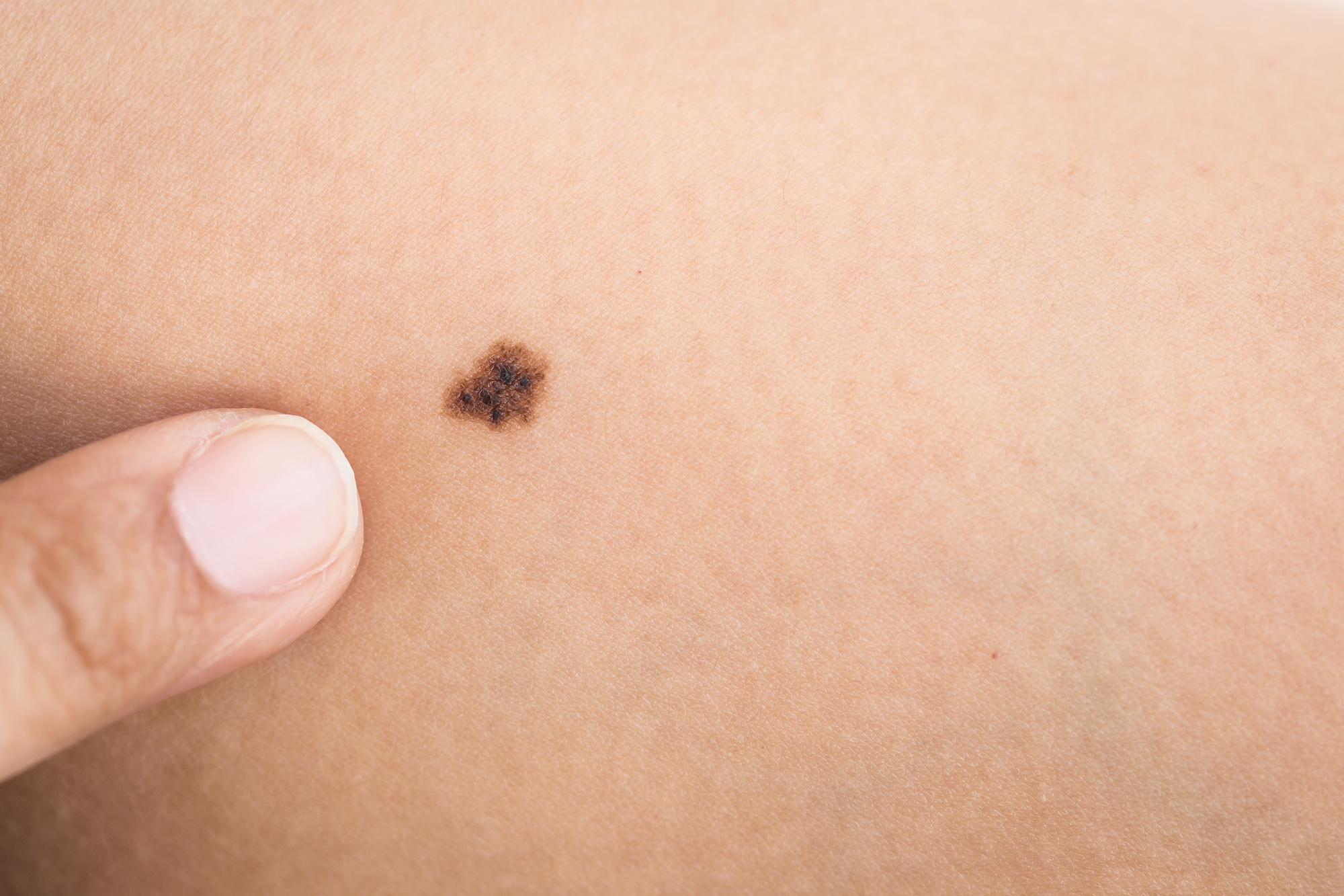 Skin Cancer Treatment in Austin, TX