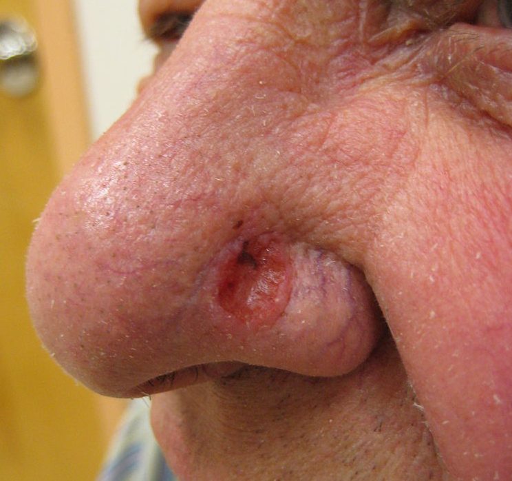 Basal Cell Carcinoma Treatment in Austin, TX