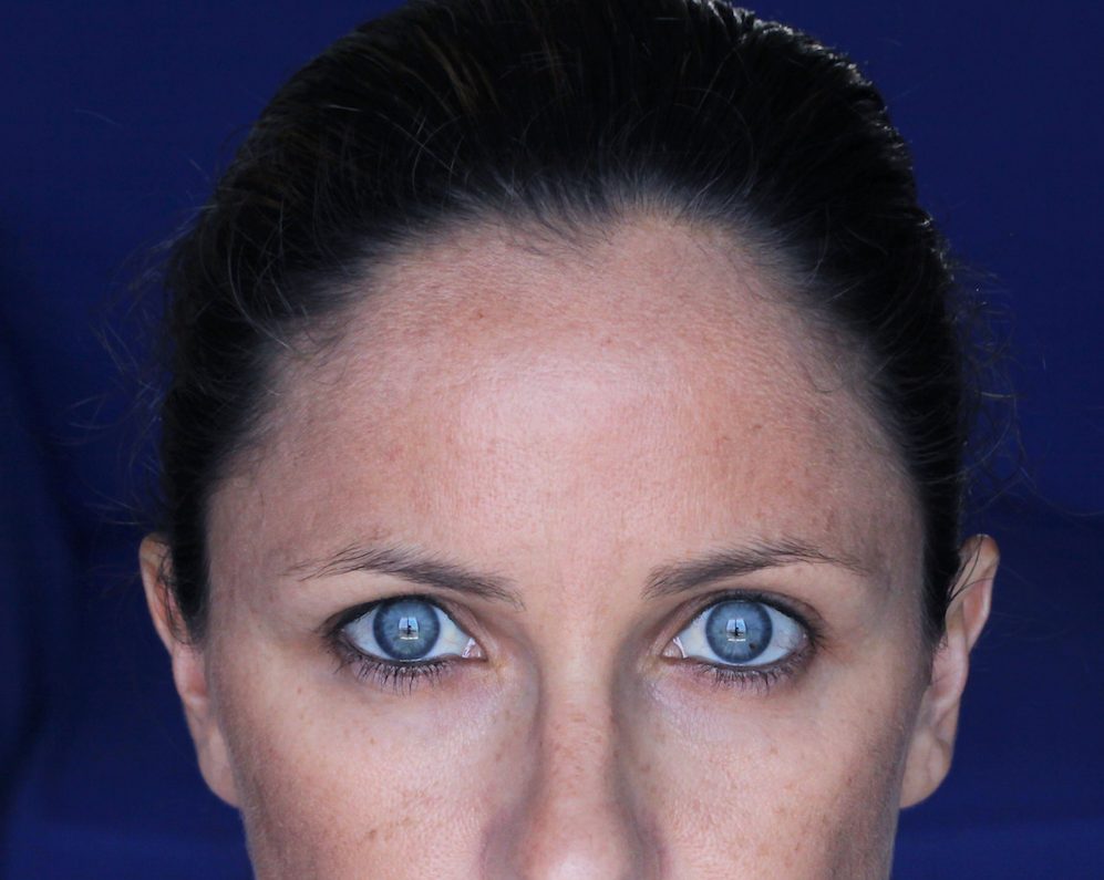 Dermal Melasma Treatment in Austin, TX