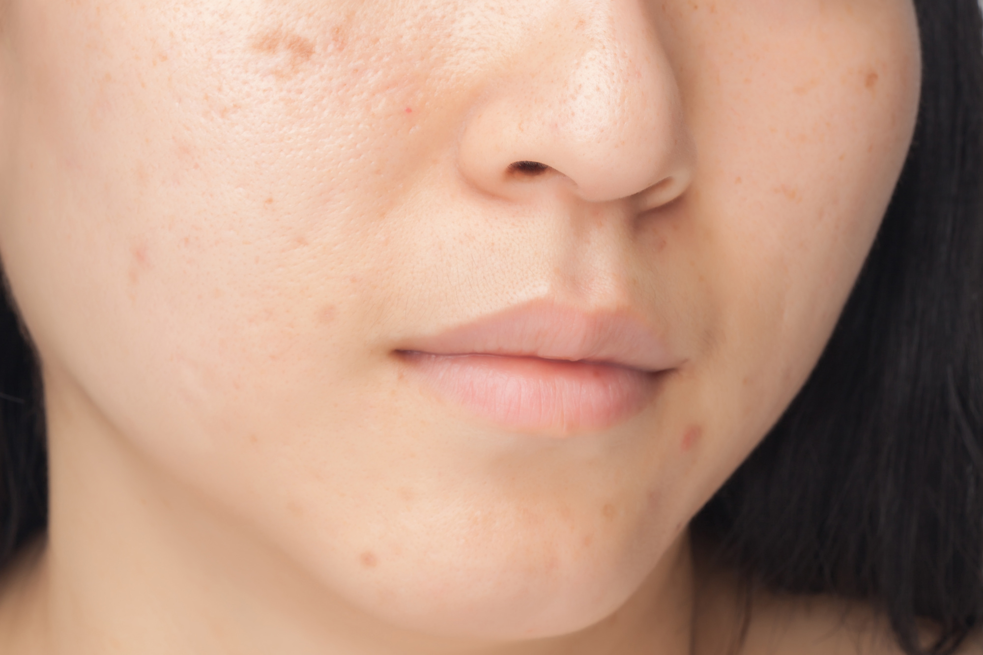 Acne Treatment in Austin, TX