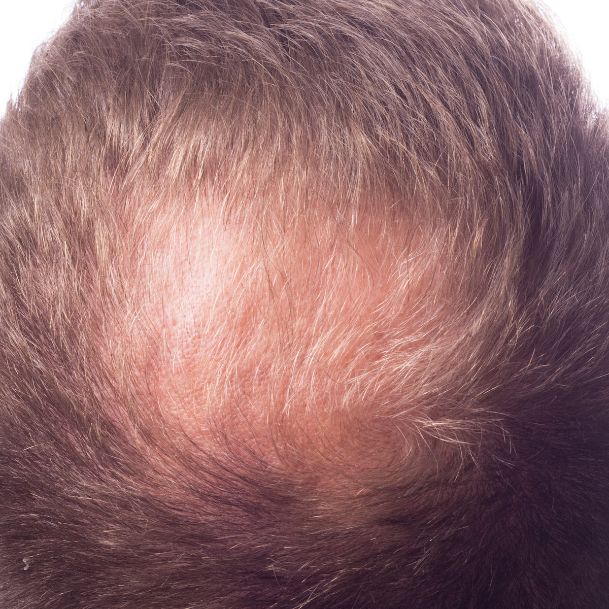 PRP for Hair Treatment