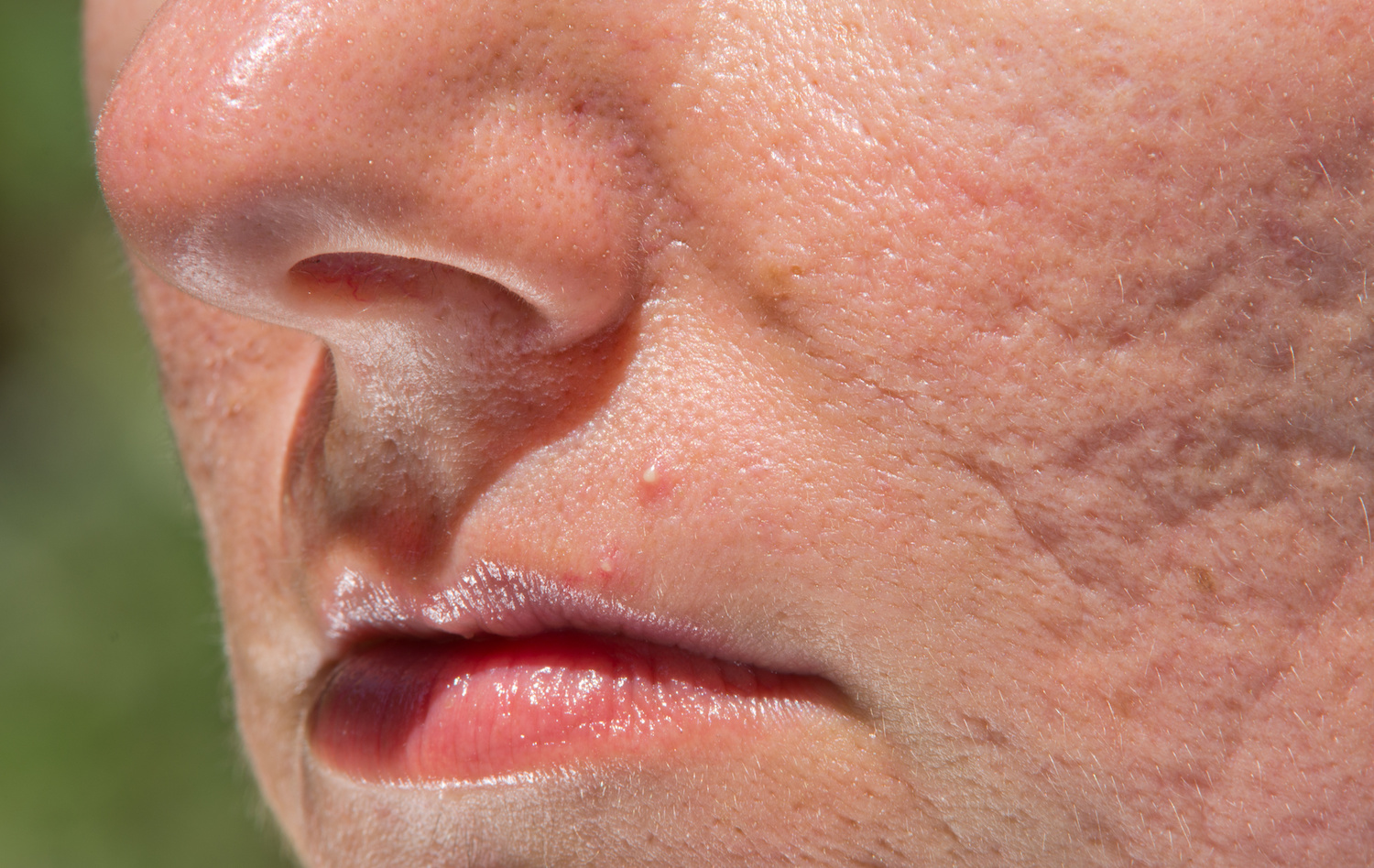 Platelet Rich Plasma + Microneedling in Austin, TX