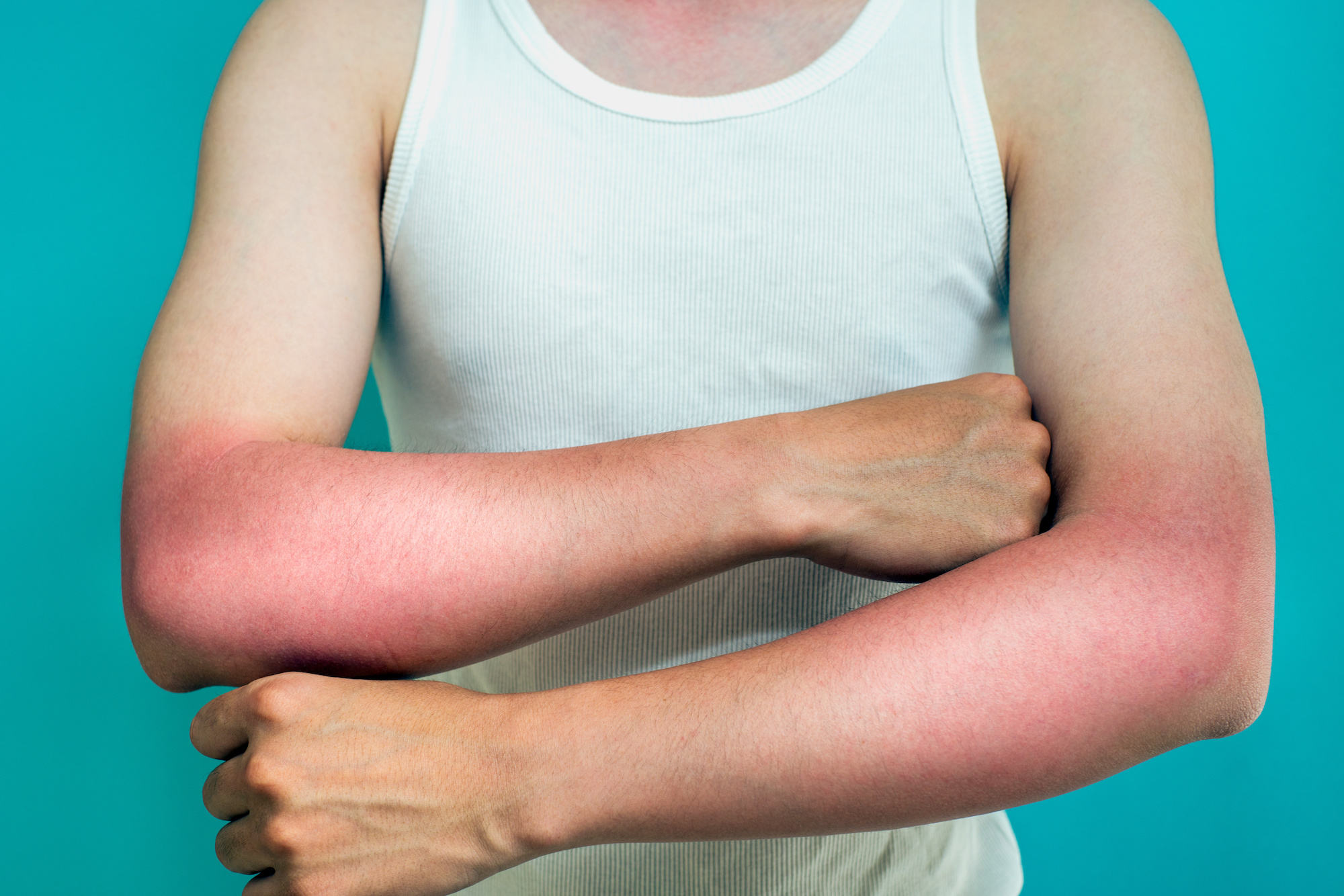 Top 5 Tips on How To Remedy A Sunburn