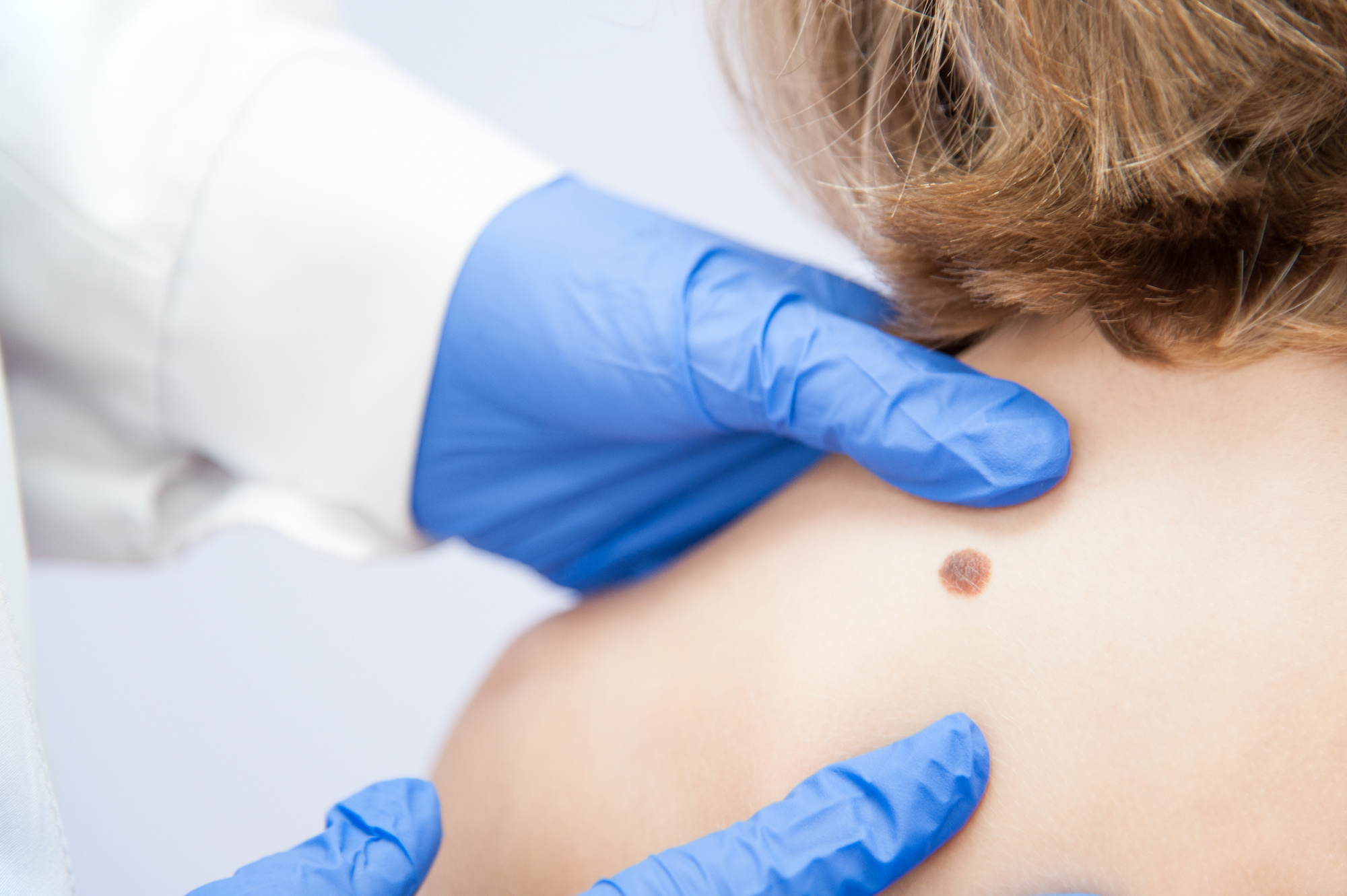 Skin Cancer Treatment in Austin, TX