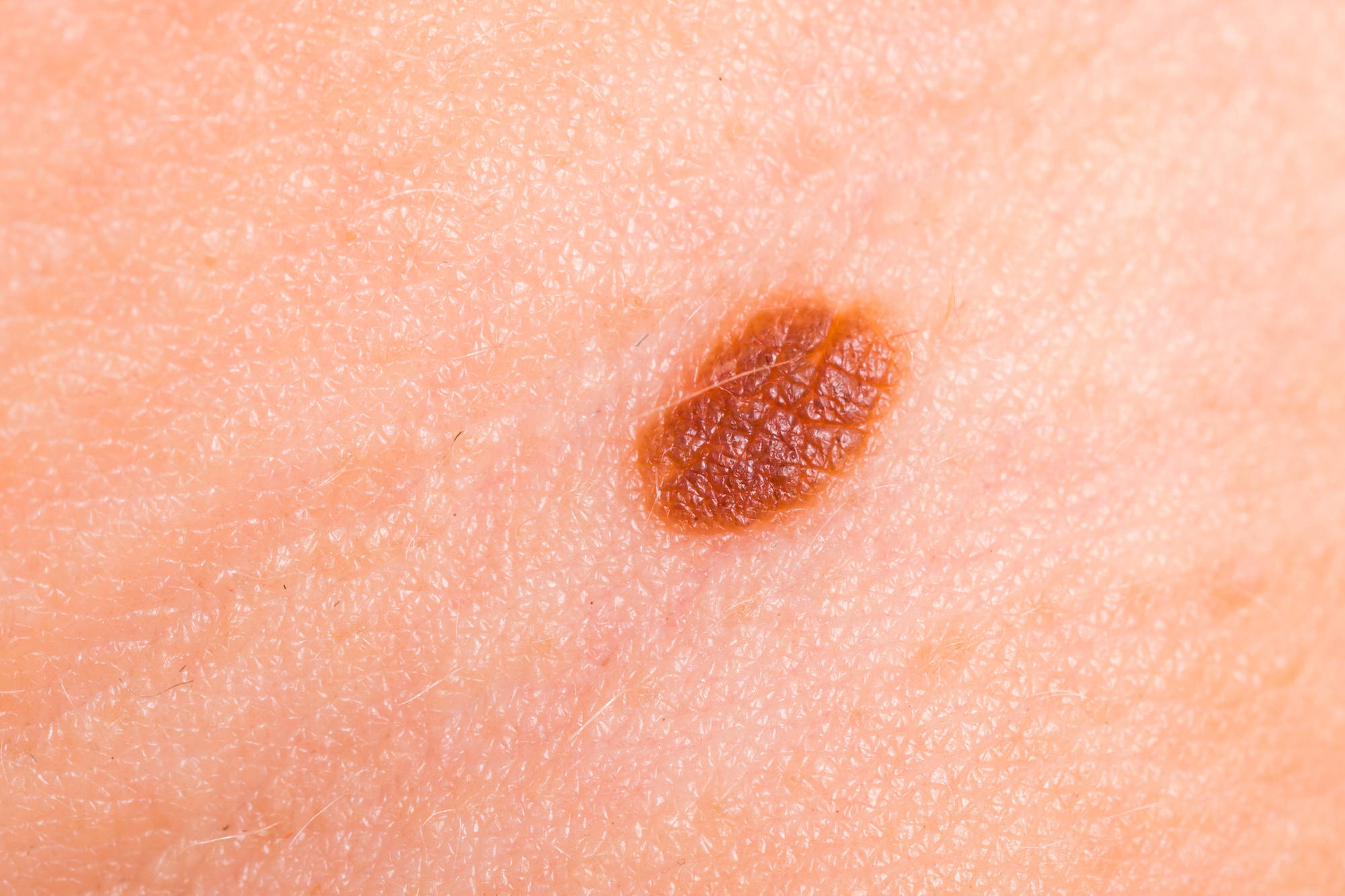 Skin Cancer Treatment in Austin, TX