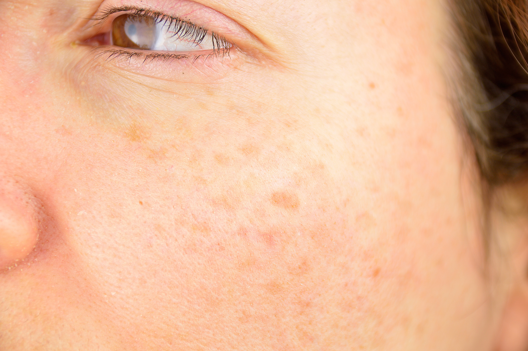 Sun Damage Treatment in Austin, TX