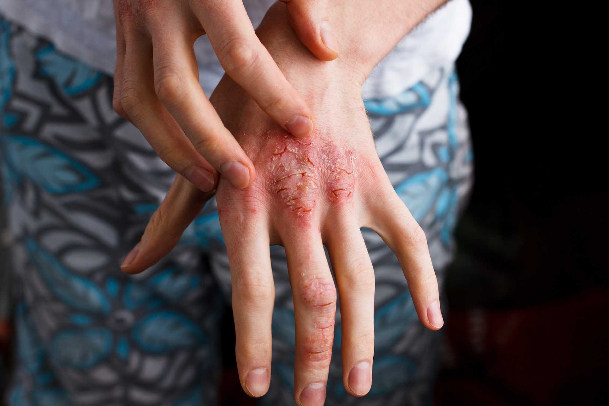 Psoriasis Treatment in Austin, TX