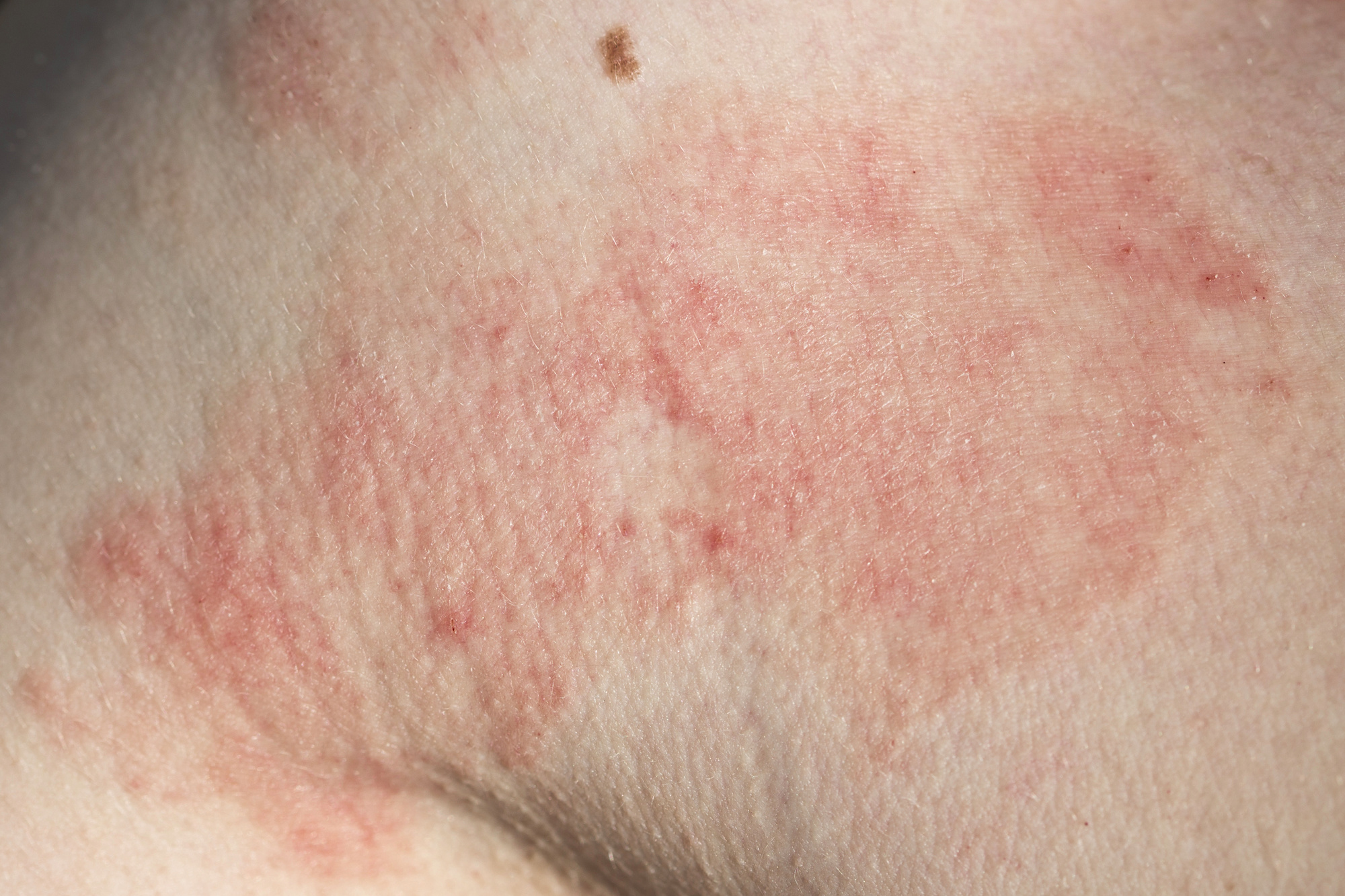 Eczema Treatment in Austin, TX