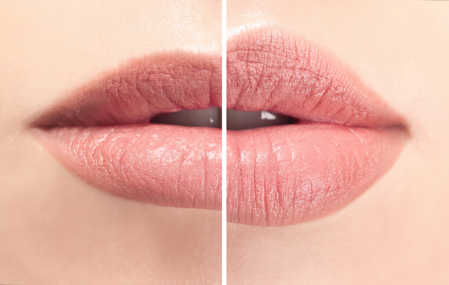 Dermal Fillers in Austin, TX