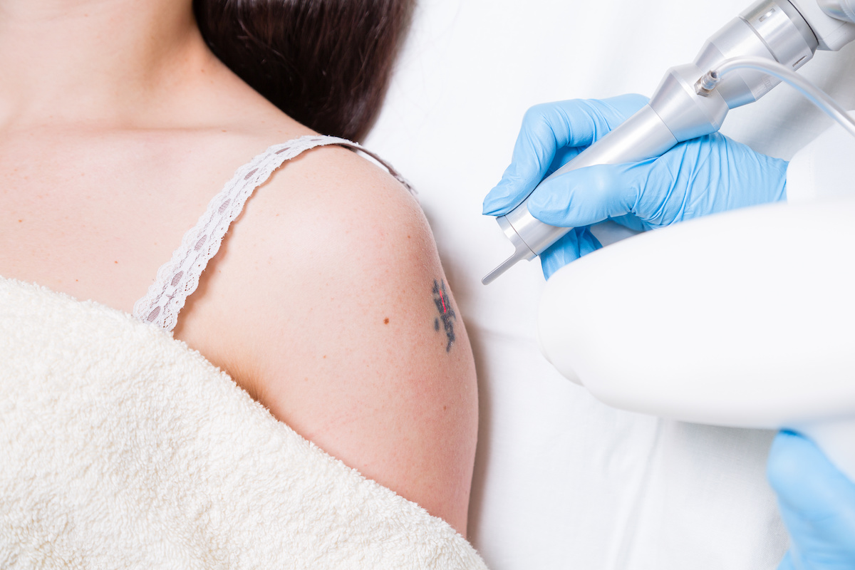 Cutera Enlighten Tattoo Removal in Austin, TX