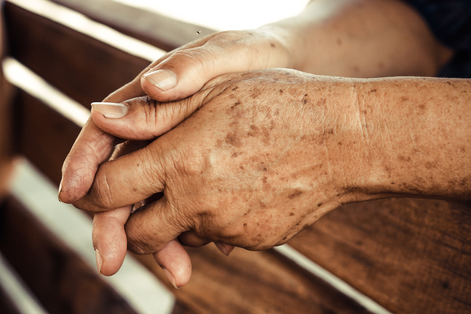 Age Spots Treatment in Austin, TX