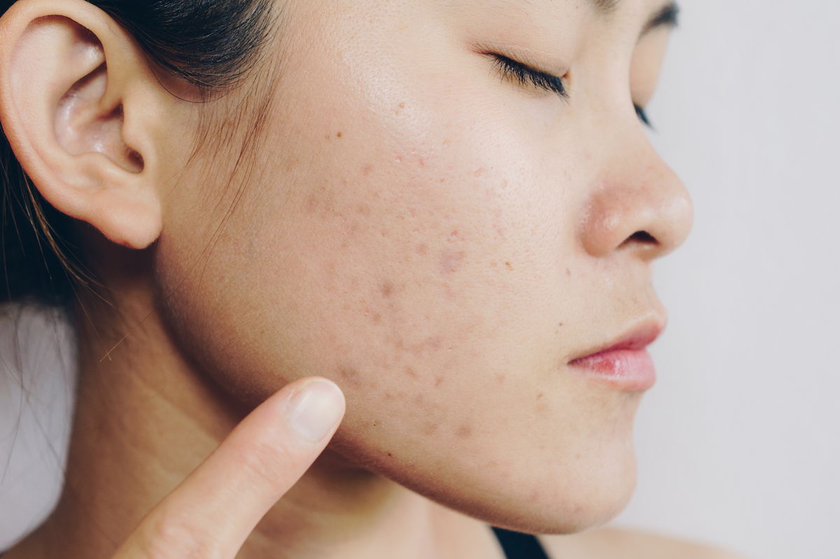 Laser Scar Reduction in Austin, TX