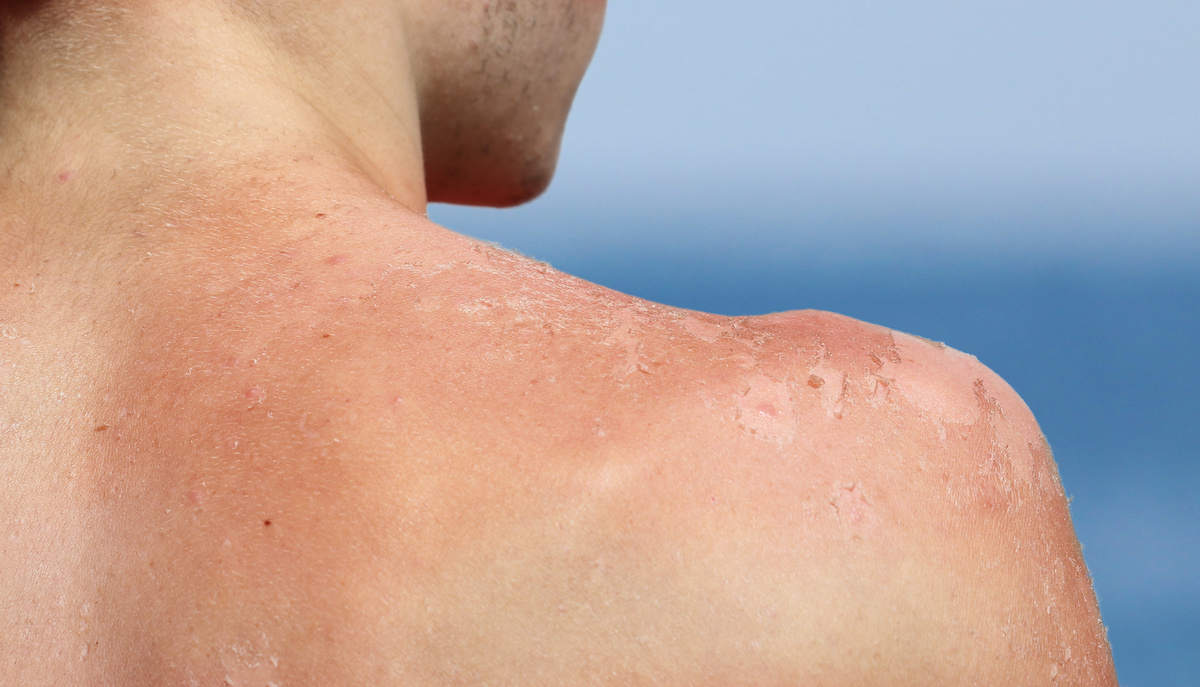 5 Things You Didn’t Know About Skin Cancer!