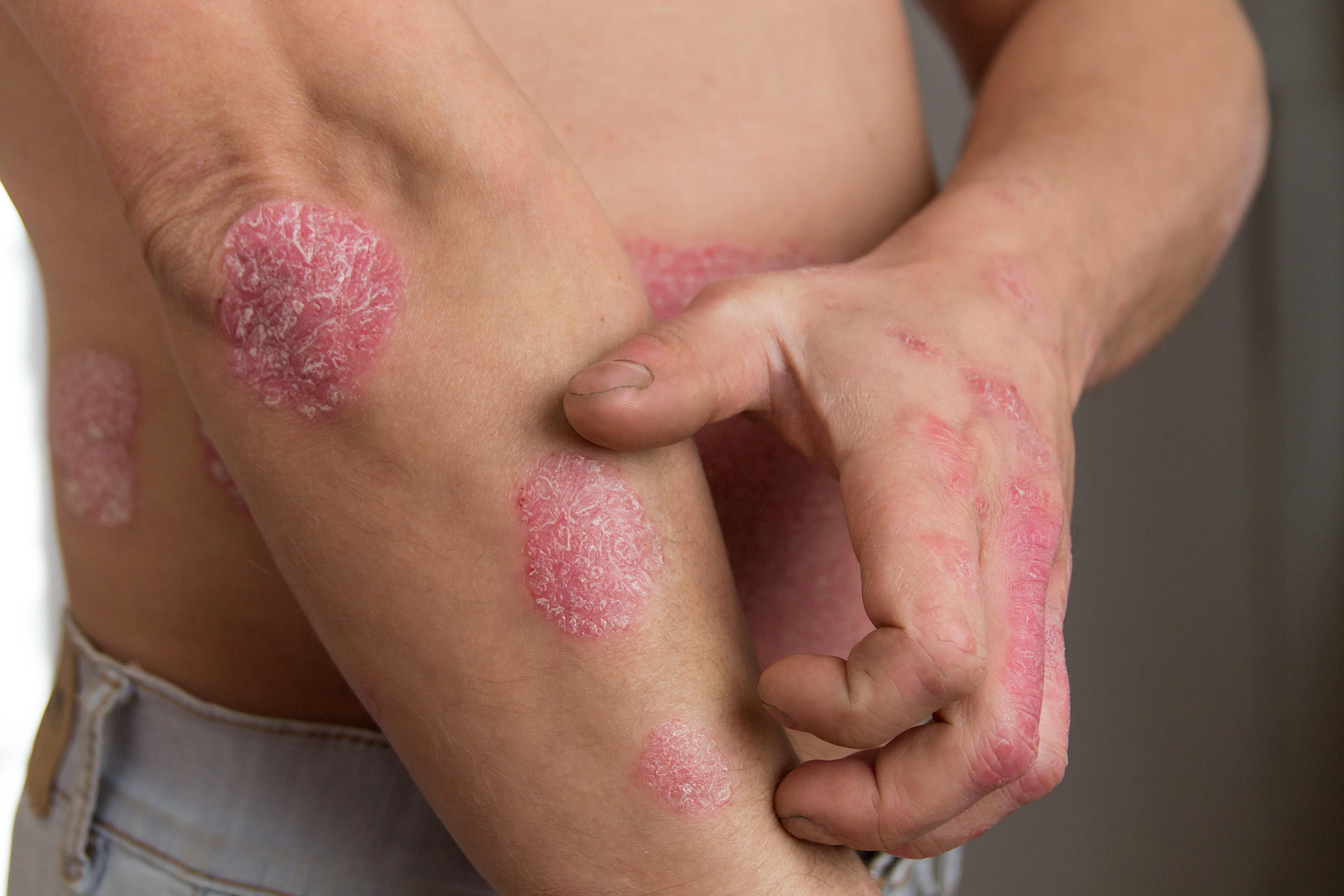 Psoriasis Treatment in Austin, TX