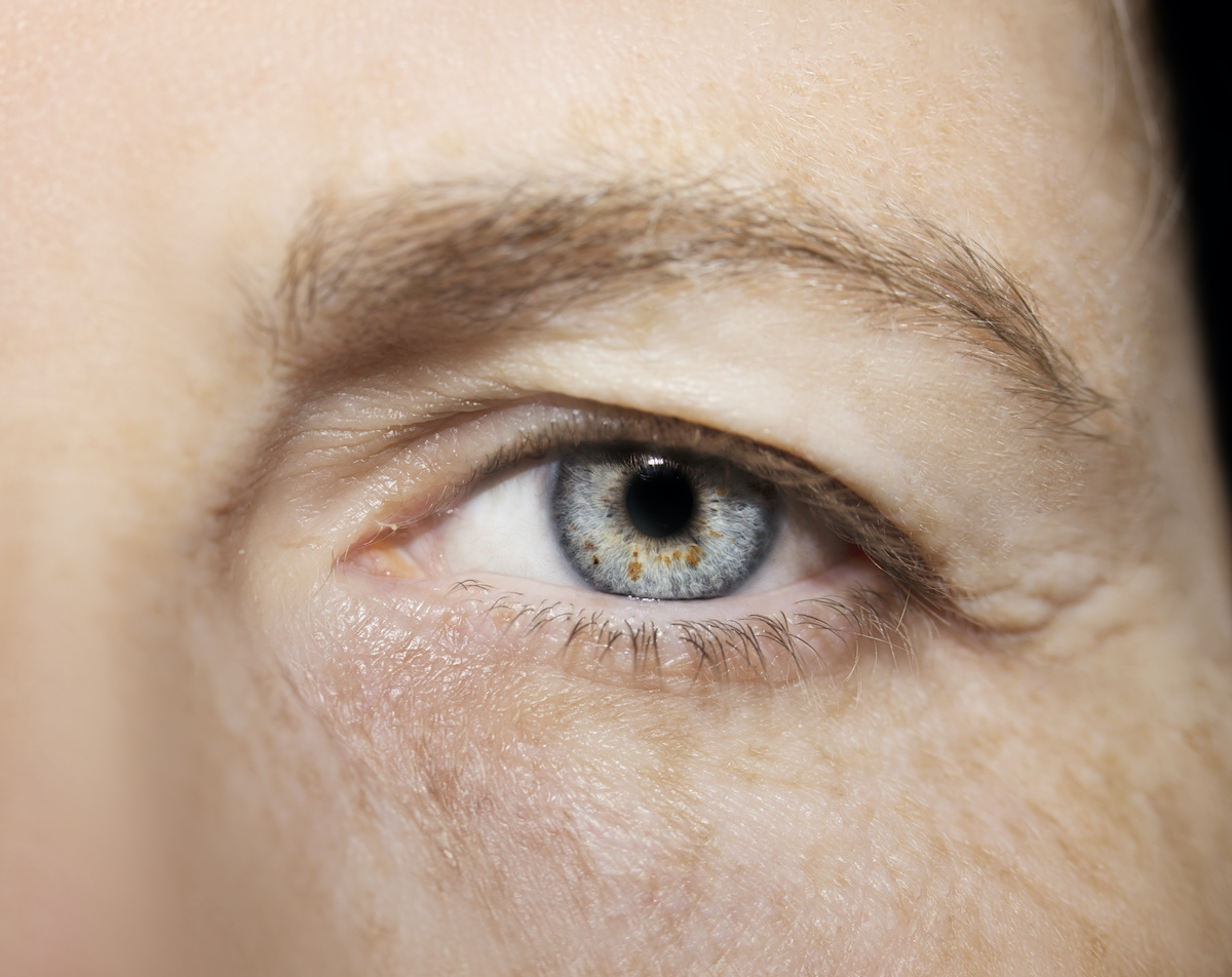 Eyelid Rejuvenation in Austin, TX