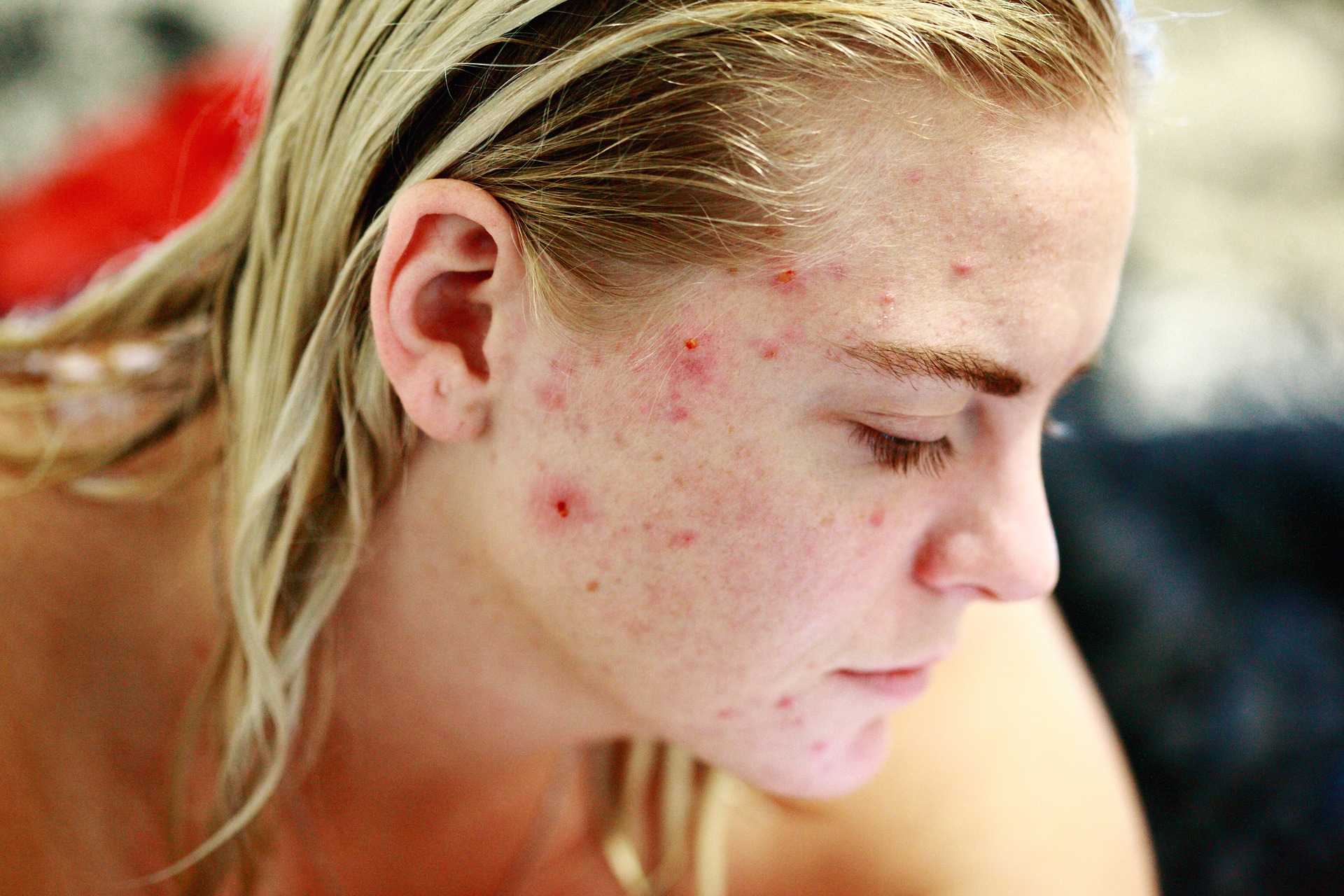 Acne Breakouts Treatment in Austin, TX