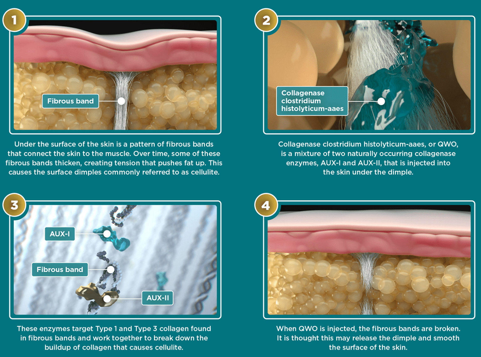 QWO The Cellulite Injectable Sanova Dermatology