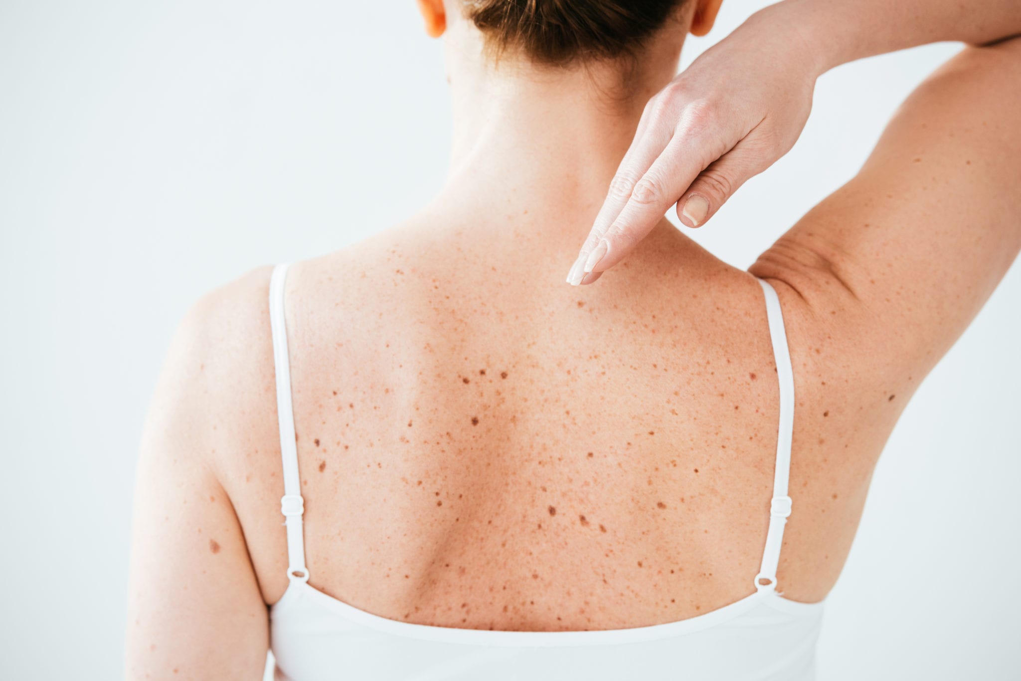 Melanoma Detection in Austin, TX