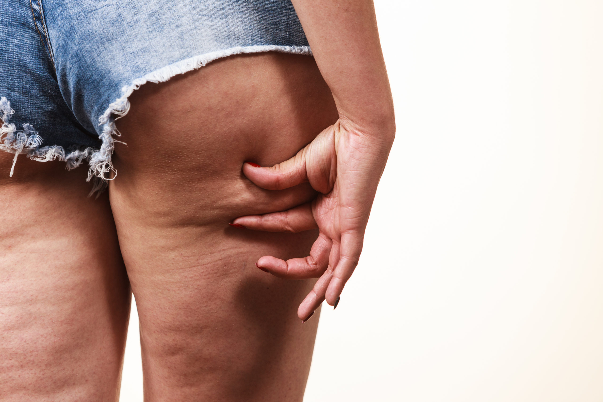 What Factors Contribute to Cellulite?