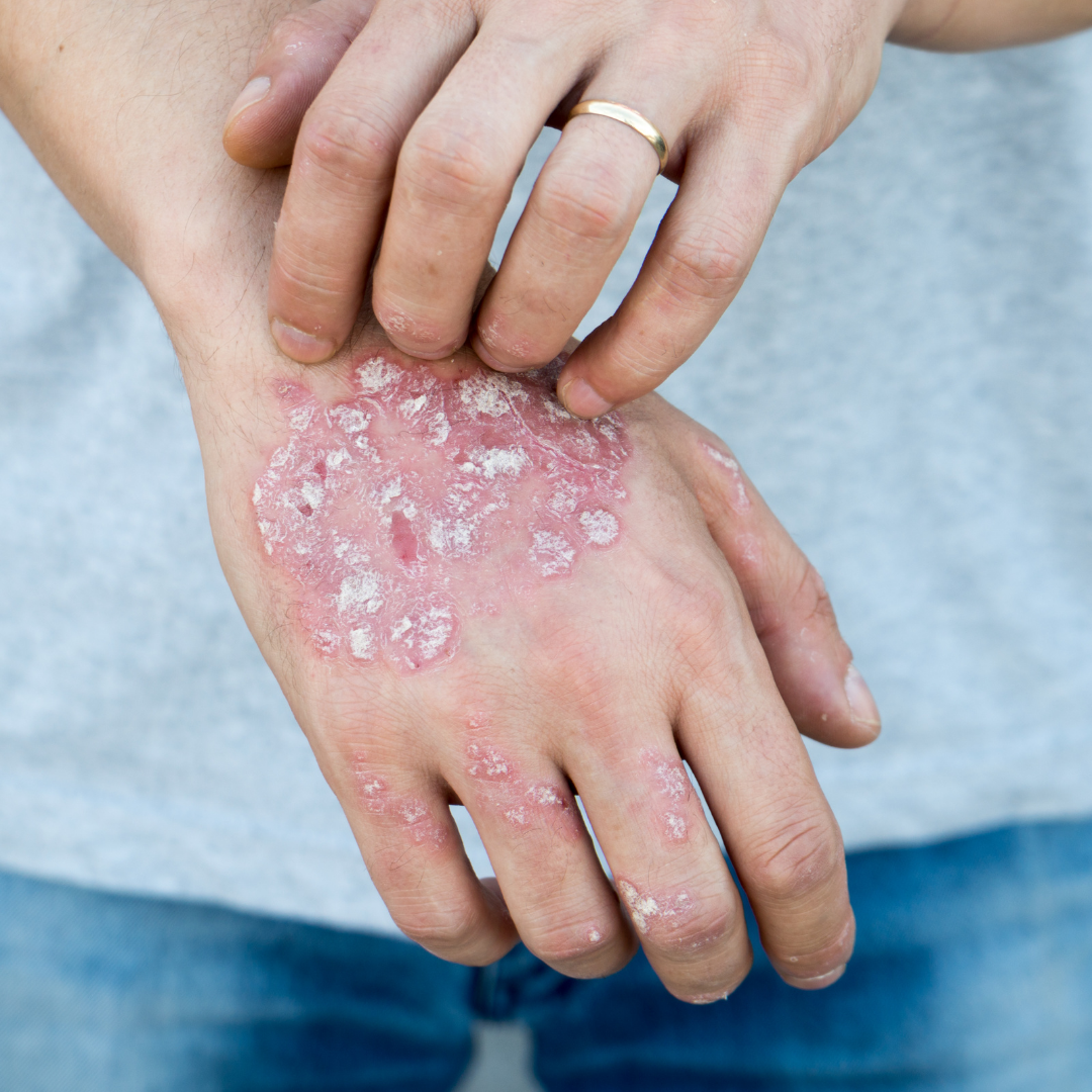 Psoriasis Treatment in Austin, TX