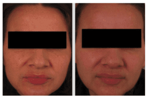 Laser Skin Rejuvenation