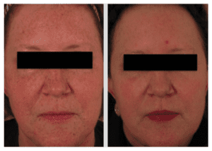 Laser Skin Rejuvenation