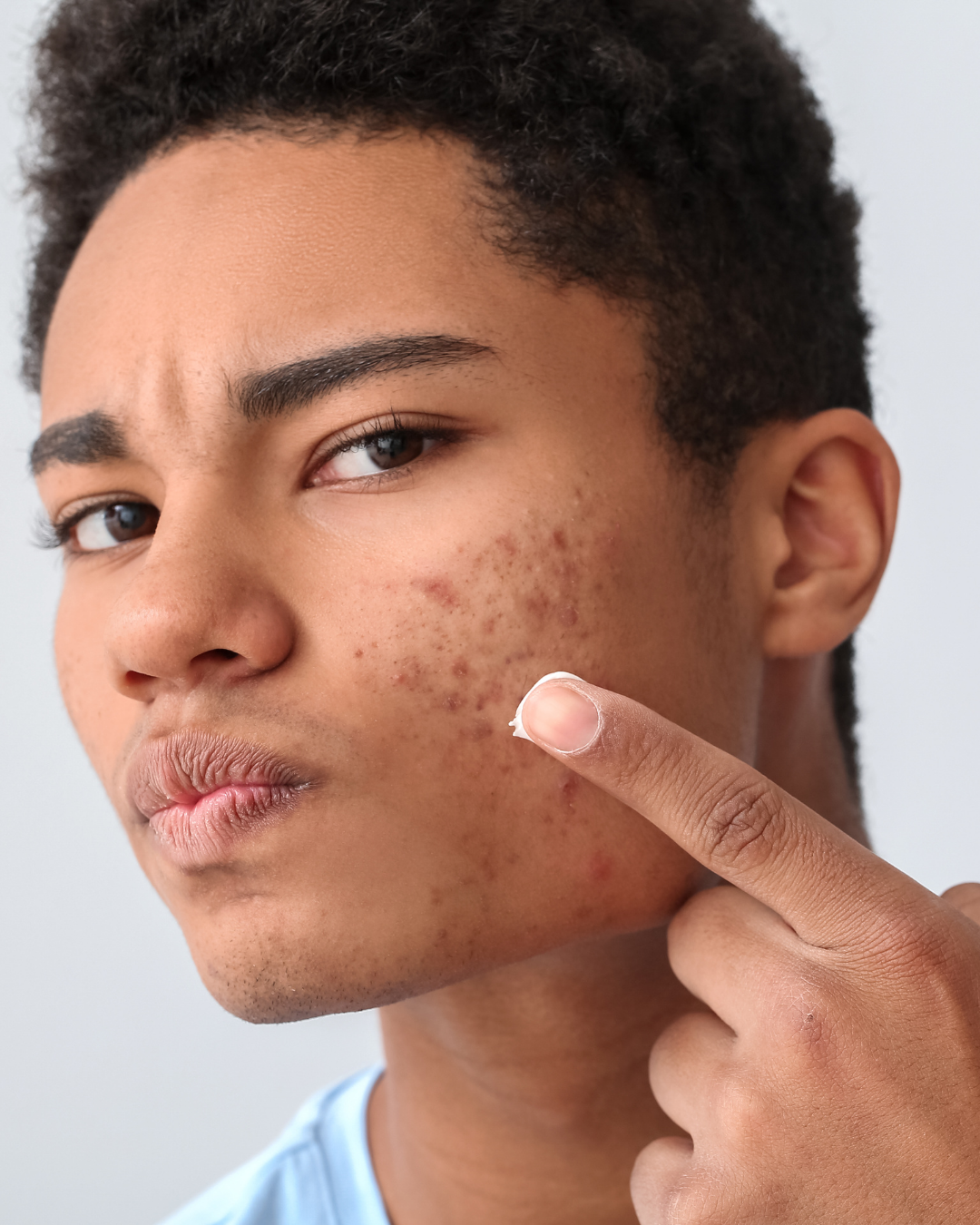 Acne Treatment in Austin, TX