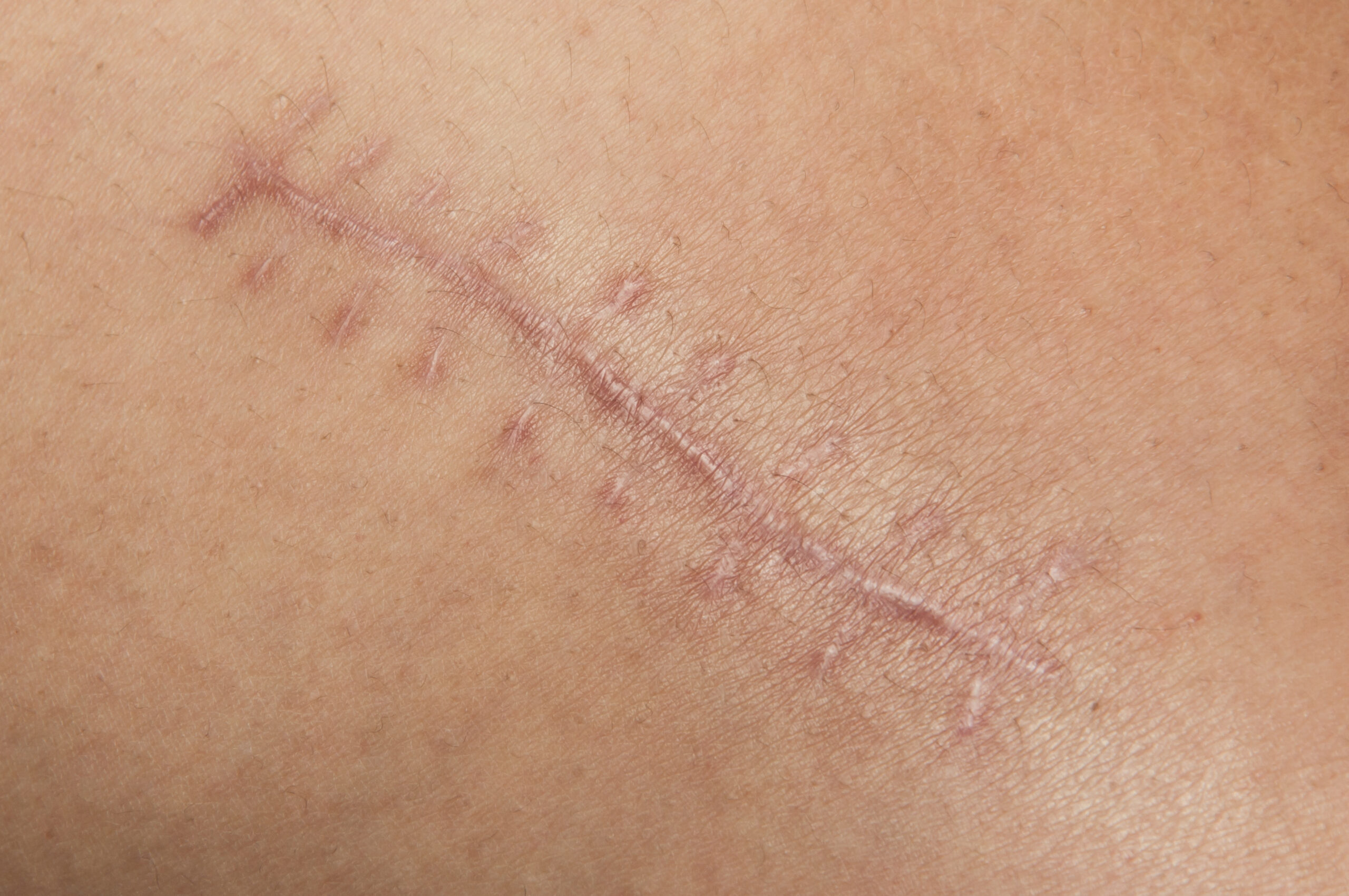 How Can DeepFX & ScaarFX Treatment Help Minimize The Appearance of My Scars?