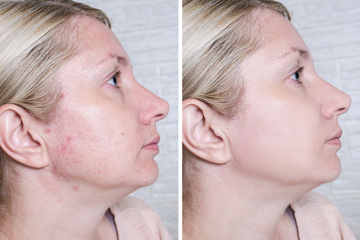Young woman before and after anti acne treatment, skincare and dermatology concept Chemical Peels for Acne