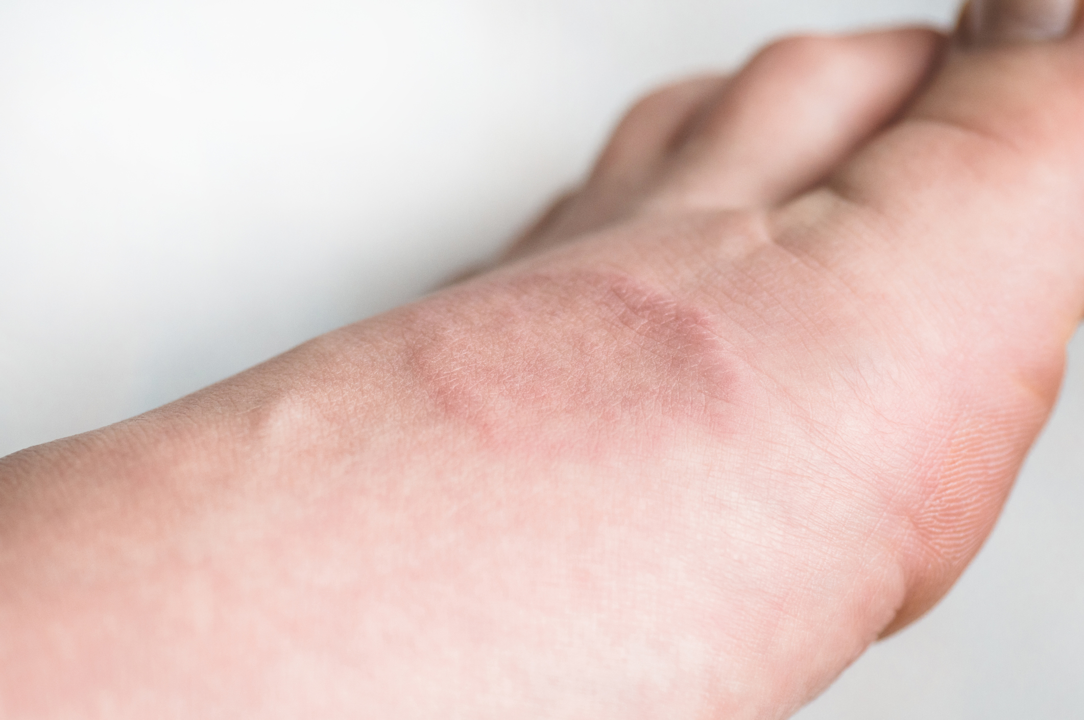 Human leg with Granuloma Annular or a pink lichen. Skin disease Granuloma Annulare
